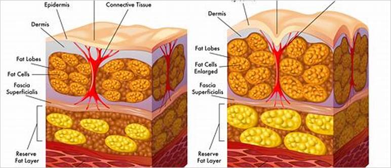 Cellulite stages pictures
